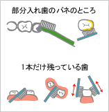 部分入れ歯のバネのところ、1本だけ残っている歯