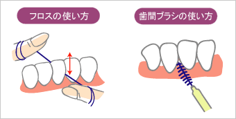 フロス、歯間ブラシの使い方