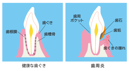 健康な歯ぐきと歯肉炎