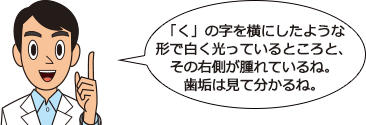 「く」の字を横にしたような形で白く光っているところと、その右側が腫れているね。歯垢は見て分かるね。