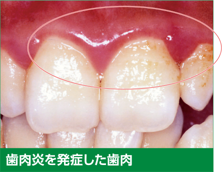 歯肉炎を発症した歯肉